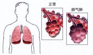 肺气肿是什么病严重吗